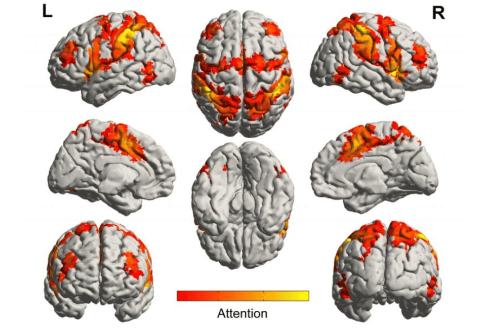 Music activates brain regions spared from Alzheimer's disease